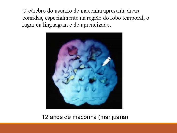 O cérebro do usuário de maconha apresenta áreas comidas, especialmente na região do lobo