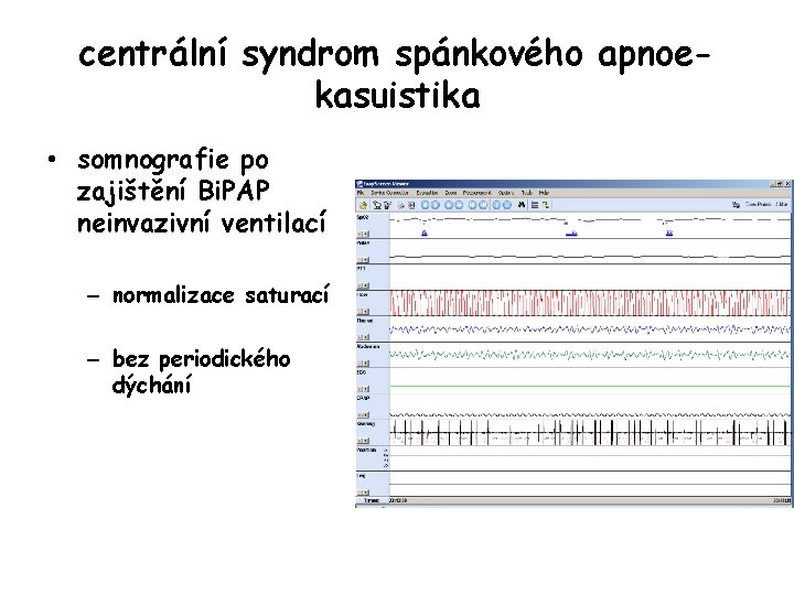 centrální syndrom spánkového apnoekasuistika • somnografie po zajištění Bi. PAP neinvazivní ventilací – normalizace