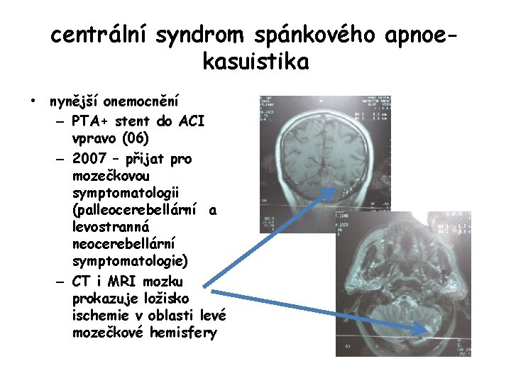 centrální syndrom spánkového apnoekasuistika • nynější onemocnění – PTA+ stent do ACI vpravo (06)