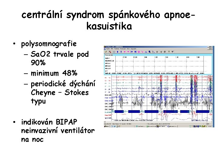 centrální syndrom spánkového apnoekasuistika • polysomnografie – Sa. O 2 trvale pod 90% –