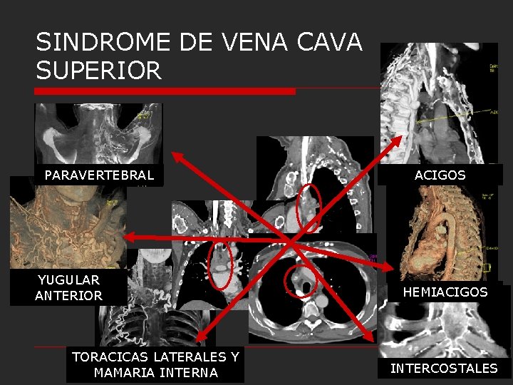 SINDROME DE VENA CAVA SUPERIOR PARAVERTEBRAL YUGULAR ANTERIOR TORACICAS LATERALES Y MAMARIA INTERNA ACIGOS SINDROME DE VENA CAVA SUPERIOR PARAVERTEBRAL YUGULAR ANTERIOR TORACICAS LATERALES Y MAMARIA INTERNA ACIGOS