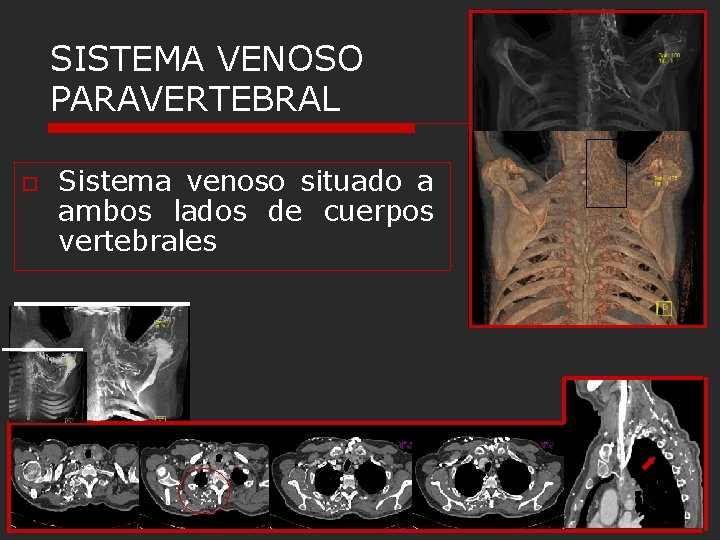 SISTEMA VENOSO PARAVERTEBRAL o Sistema venoso situado a ambos lados de cuerpos vertebrales SISTEMA VENOSO PARAVERTEBRAL o Sistema venoso situado a ambos lados de cuerpos vertebrales