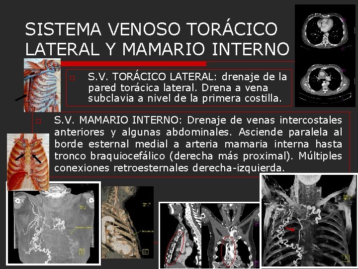 SISTEMA VENOSO TORÁCICO LATERAL Y MAMARIO INTERNO o o S. V. TORÁCICO LATERAL: drenaje SISTEMA VENOSO TORÁCICO LATERAL Y MAMARIO INTERNO o o S. V. TORÁCICO LATERAL: drenaje