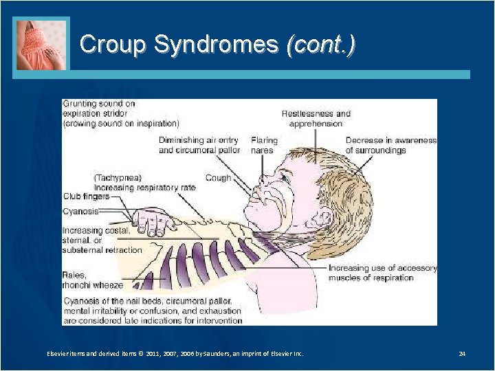 Croup Syndromes (cont. ) Elsevier items and derived items © 2011, 2007, 2006 by Croup Syndromes (cont. ) Elsevier items and derived items © 2011, 2007, 2006 by