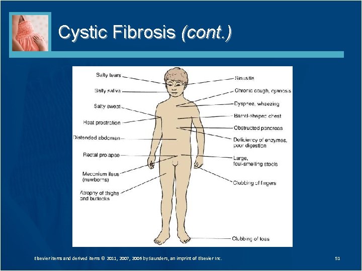 Cystic Fibrosis (cont. ) Elsevier items and derived items © 2011, 2007, 2006 by Cystic Fibrosis (cont. ) Elsevier items and derived items © 2011, 2007, 2006 by