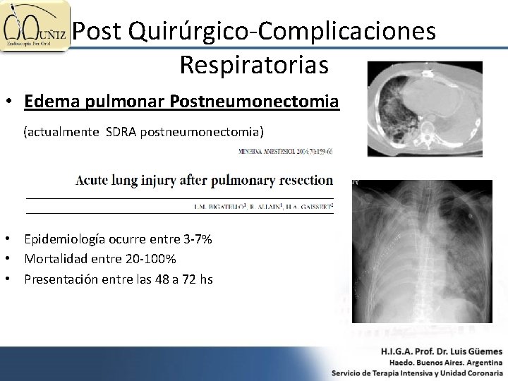 Post Quirúrgico-Complicaciones Respiratorias • Edema pulmonar Postneumonectomia (actualmente SDRA postneumonectomia) • Epidemiología ocurre entre