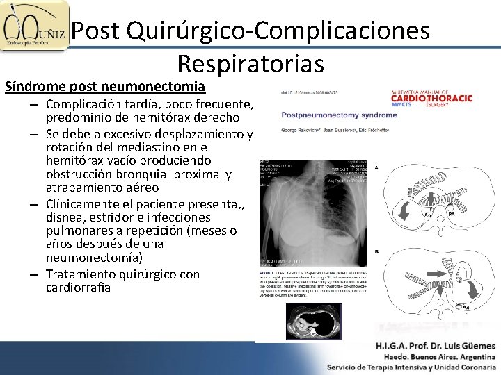 Post Quirúrgico-Complicaciones Respiratorias Síndrome post neumonectomia – Complicación tardía, poco frecuente, predominio de hemitórax