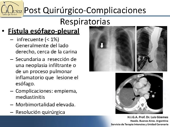 Post Quirúrgico-Complicaciones Respiratorias • Fístula esófago-pleural – infrecuente (< 1%) Generalmente del lado derecho,