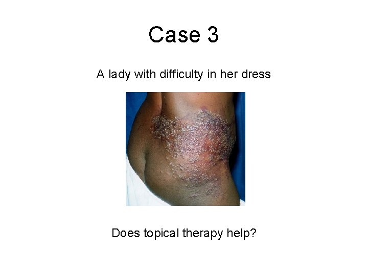Case 3 A lady with difficulty in her dress Does topical therapy help? Case 3 A lady with difficulty in her dress Does topical therapy help?