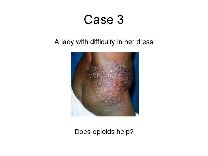 Case 3 A lady with difficulty in her dress Does opioids help? Case 3 A lady with difficulty in her dress Does opioids help?
