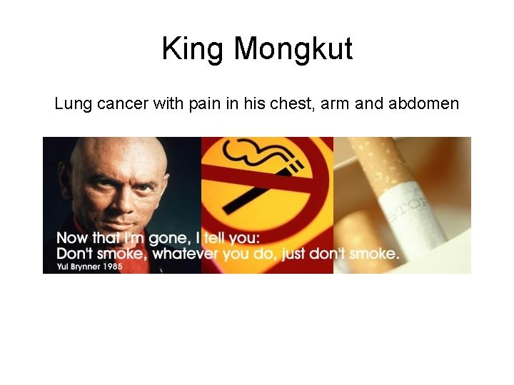 King Mongkut Lung cancer with pain in his chest, arm and abdomen King Mongkut Lung cancer with pain in his chest, arm and abdomen