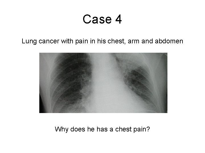Case 4 Lung cancer with pain in his chest, arm and abdomen Why does Case 4 Lung cancer with pain in his chest, arm and abdomen Why does