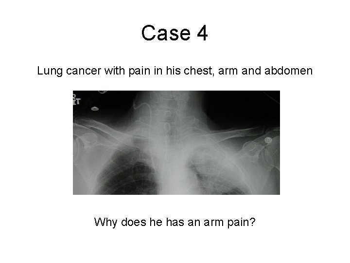 Case 4 Lung cancer with pain in his chest, arm and abdomen Why does Case 4 Lung cancer with pain in his chest, arm and abdomen Why does