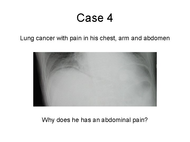 Case 4 Lung cancer with pain in his chest, arm and abdomen Why does Case 4 Lung cancer with pain in his chest, arm and abdomen Why does