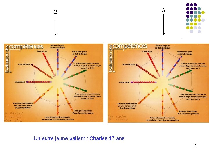 2 3 Un autre jeune patient : Charles 17 ans 15 