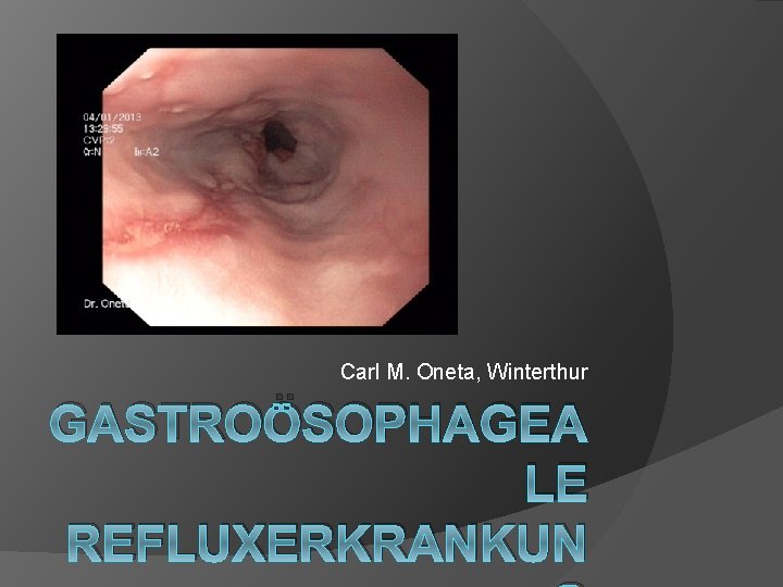 Carl M. Oneta, Winterthur GASTROÖSOPHAGEA LE REFLUXERKRANKUN Carl M. Oneta, Winterthur GASTROÖSOPHAGEA LE REFLUXERKRANKUN