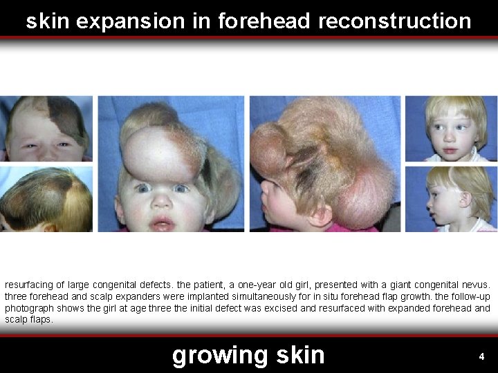 skin expansion in forehead reconstruction resurfacing of large congenital defects. the patient, a one-year