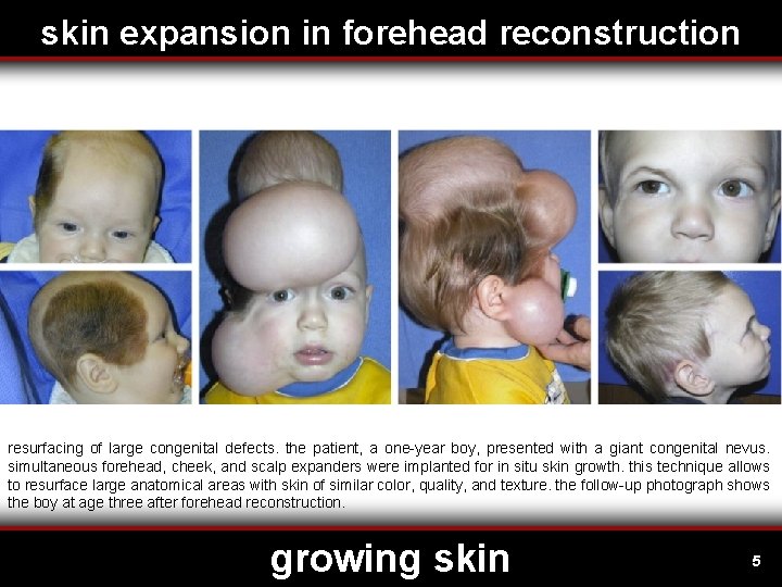 skin expansion in forehead reconstruction resurfacing of large congenital defects. the patient, a one-year
