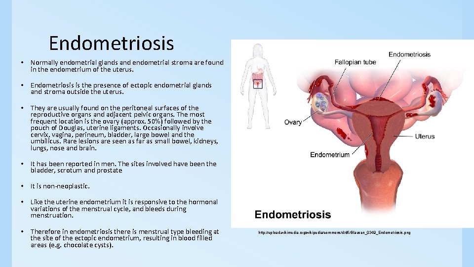 Endometriosis • Normally endometrial glands and endometrial stroma are found in the endometrium of