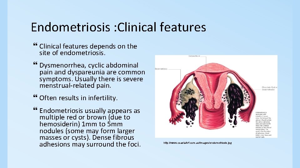 Endometriosis : Clinical features depends on the site of endometriosis. Dysmenorrhea, cyclic abdominal pain