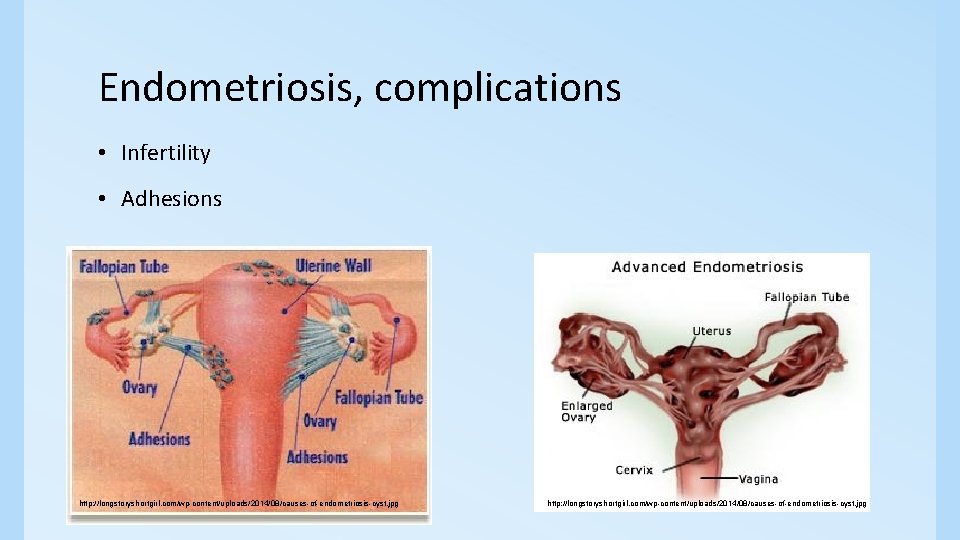 Endometriosis, complications • Infertility • Adhesions http: //longstoryshortgirl. com/wp-content/uploads/2014/08/causes-of-endometriosis-cyst. jpg 