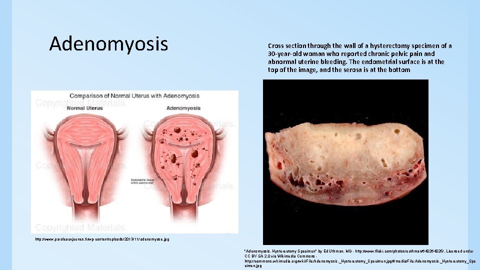 Adenomyosis Cross section through the wall of a hysterectomy specimen of a 30 -year-old