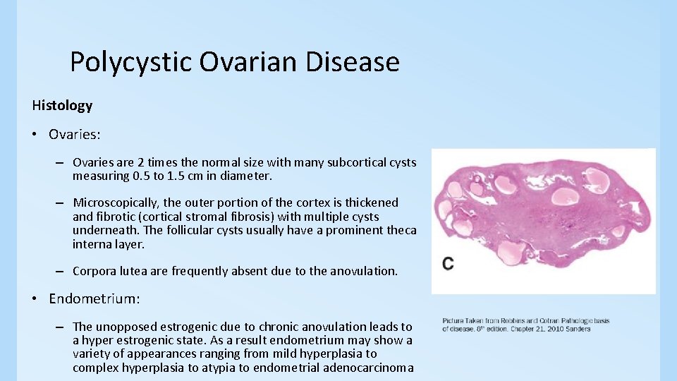 Polycystic Ovarian Disease and Endometriosis Pathology KSU Riyadh