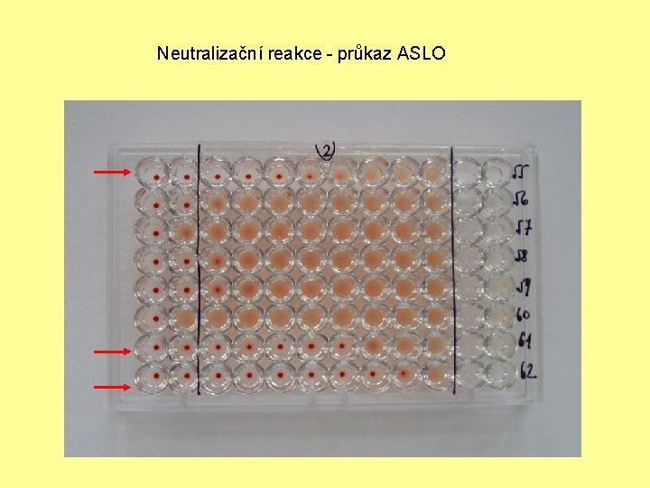 Neutralizační reakce - průkaz ASLO 