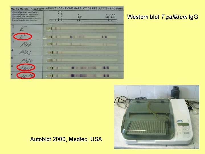 Western blot T. pallidum Ig. G Autoblot 2000, Medtec, USA 