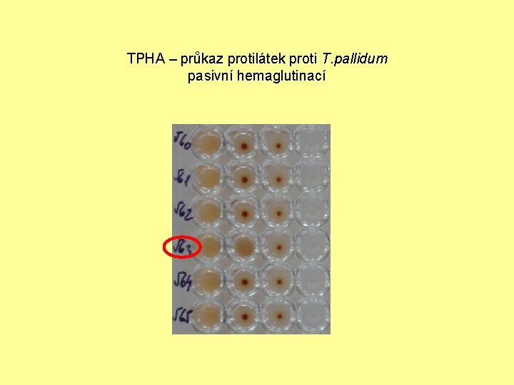 TPHA – průkaz protilátek proti T. pallidum pasivní hemaglutinací 