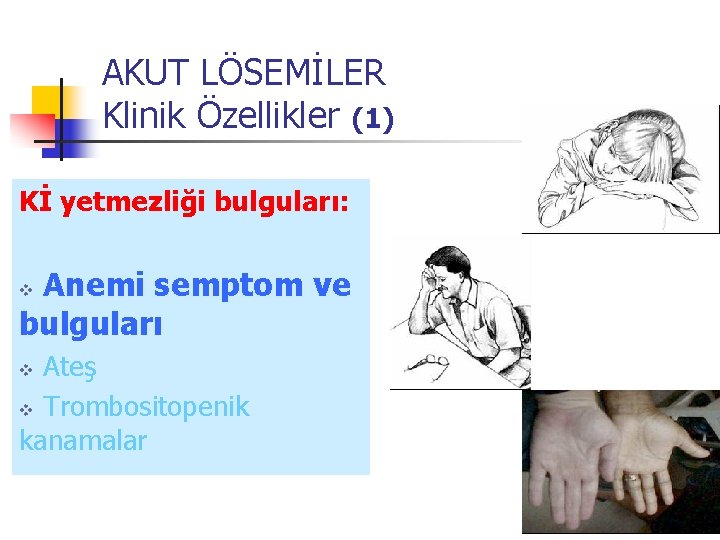 AKUT LÖSEMİLER Klinik Özellikler (1) Kİ yetmezliği bulguları: Anemi semptom ve bulguları v Ateş