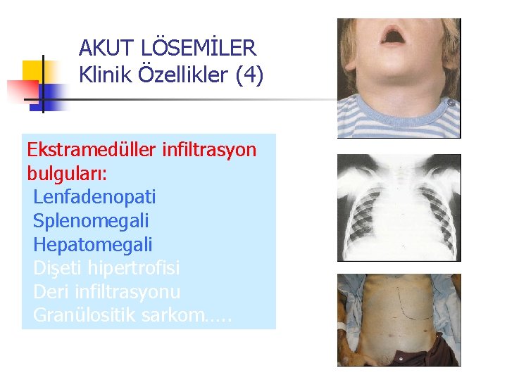 AKUT LÖSEMİLER Klinik Özellikler (4) Ekstramedüller infiltrasyon bulguları: Lenfadenopati Splenomegali Hepatomegali Dişeti hipertrofisi Deri