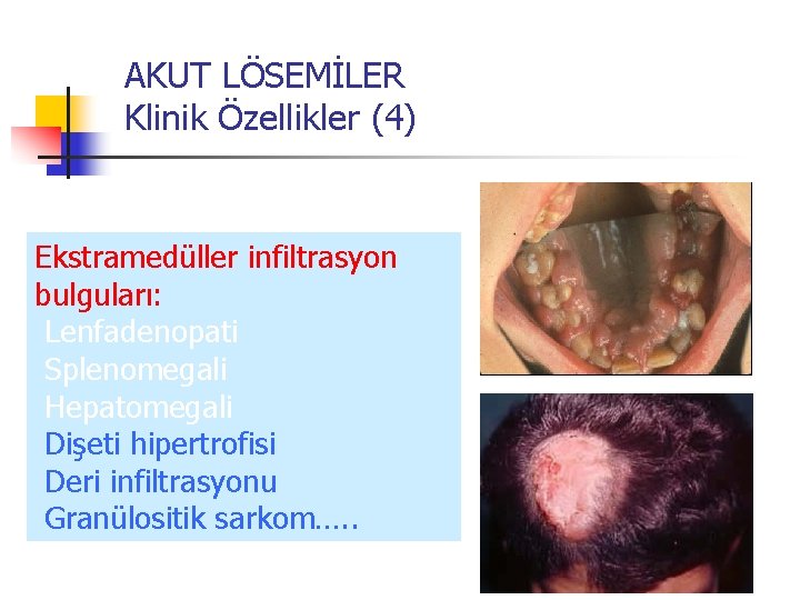 AKUT LÖSEMİLER Klinik Özellikler (4) Ekstramedüller infiltrasyon bulguları: Lenfadenopati Splenomegali Hepatomegali Dişeti hipertrofisi Deri