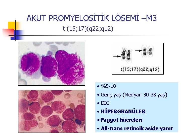 AKUT PROMYELOSİTİK LÖSEMİ –M 3 t (15; 17)(q 22; q 12) • %5 -10