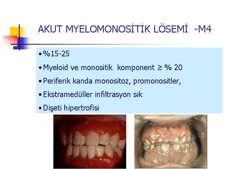 AKUT MYELOMONOSİTİK LÖSEMİ -M 4 • %15 -25 • Myeloid ve monositik komponent ≥