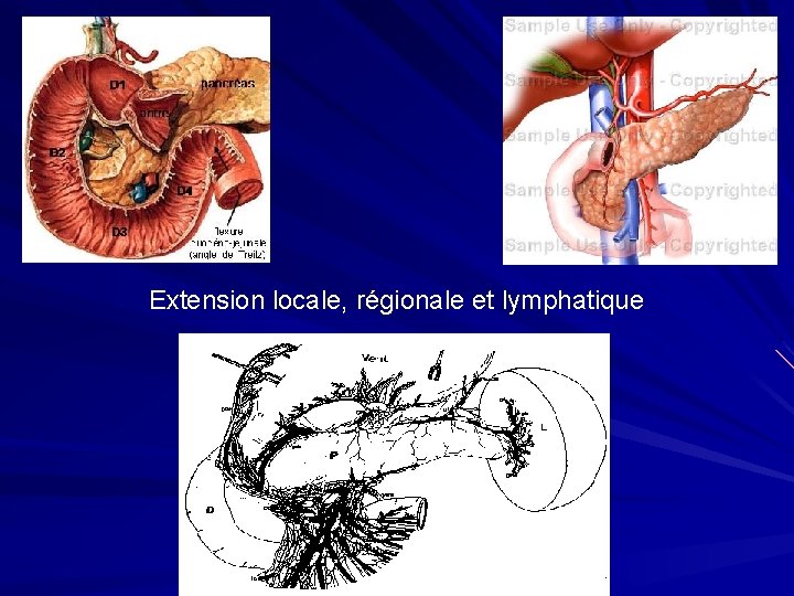 Extension locale, régionale et lymphatique 