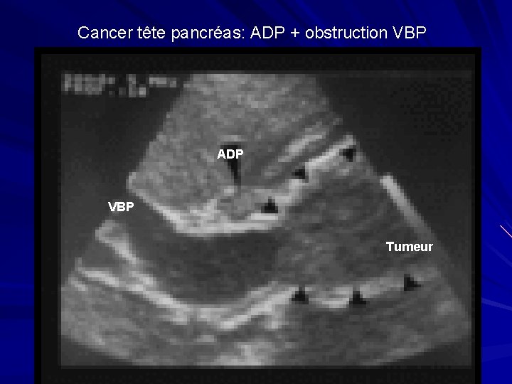 Cancer tête pancréas: ADP + obstruction VBP ADP VBP Tumeur 