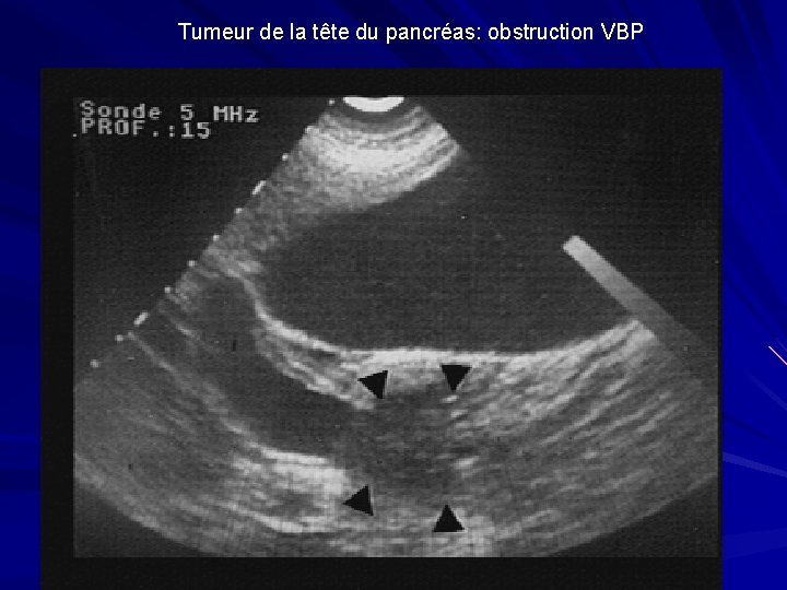 Tumeur de la tête du pancréas: obstruction VBP 