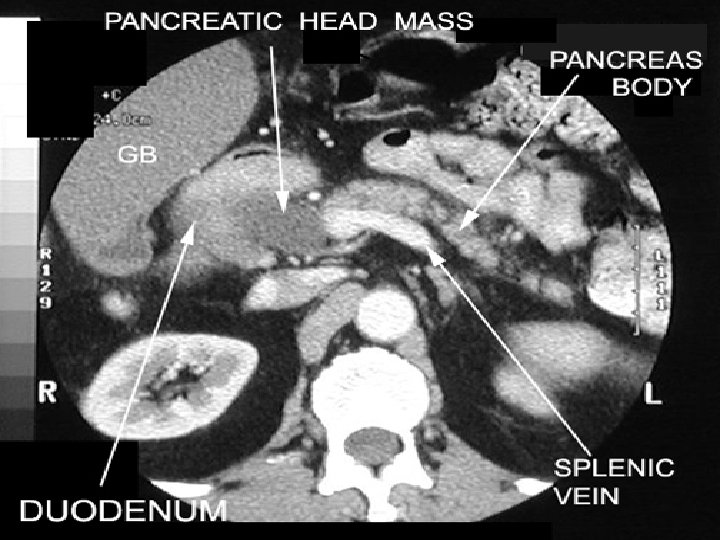  Cancer de la tête du pancréas 