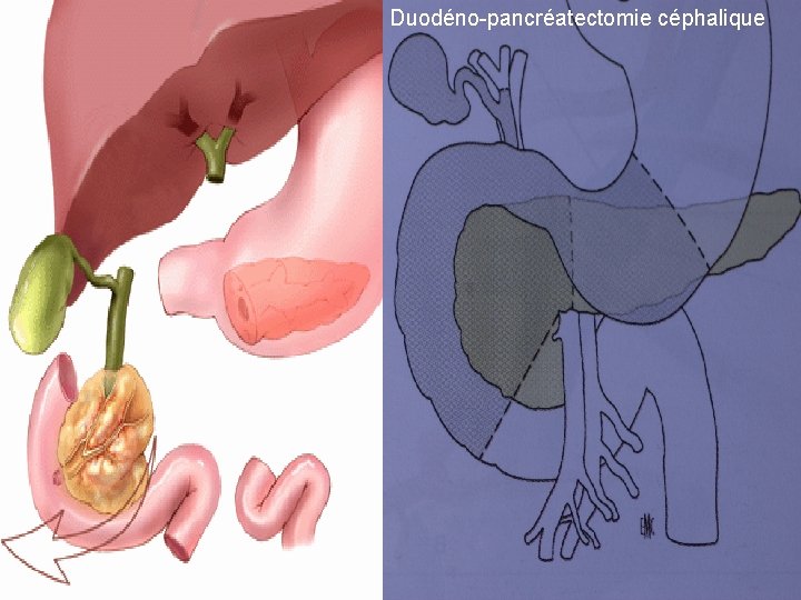 Duodéno-pancréatectomie céphalique 