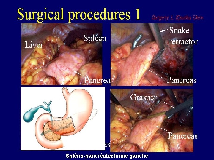 Spléno-pancréatectomie gauche 