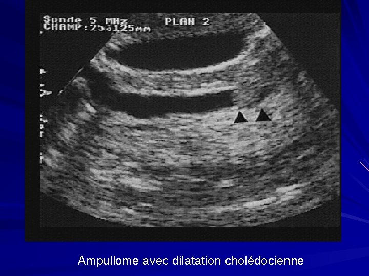 Ampullome avec dilatation cholédocienne 