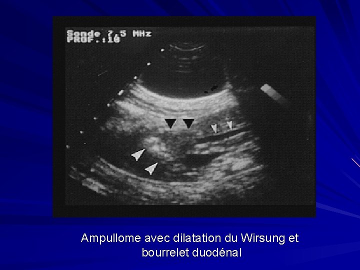 Ampullome avec dilatation du Wirsung et bourrelet duodénal 