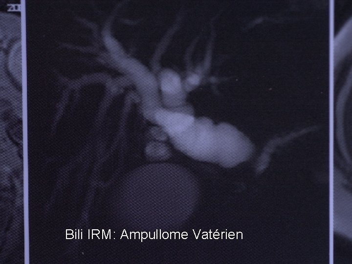 Bili IRM: Ampullome Vatérien 