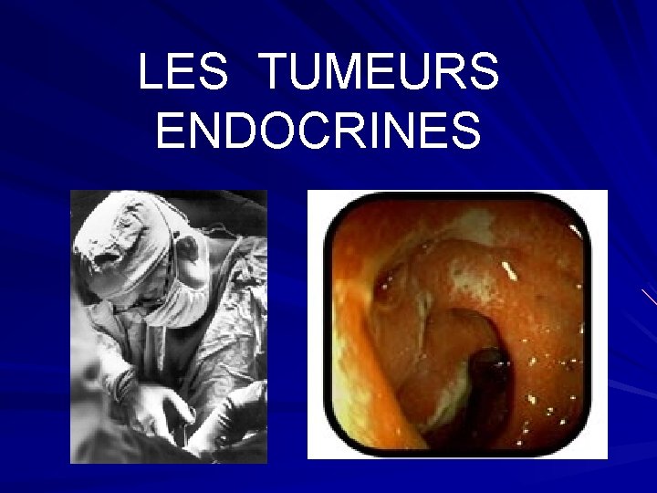 LES TUMEURS ENDOCRINES 