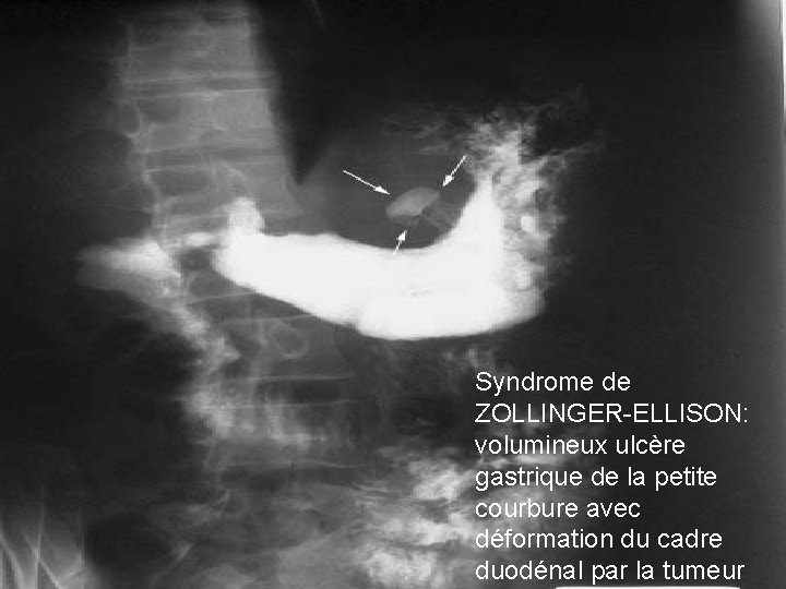 Syndrome de ZOLLINGER-ELLISON: volumineux ulcère gastrique de la petite courbure avec déformation du cadre