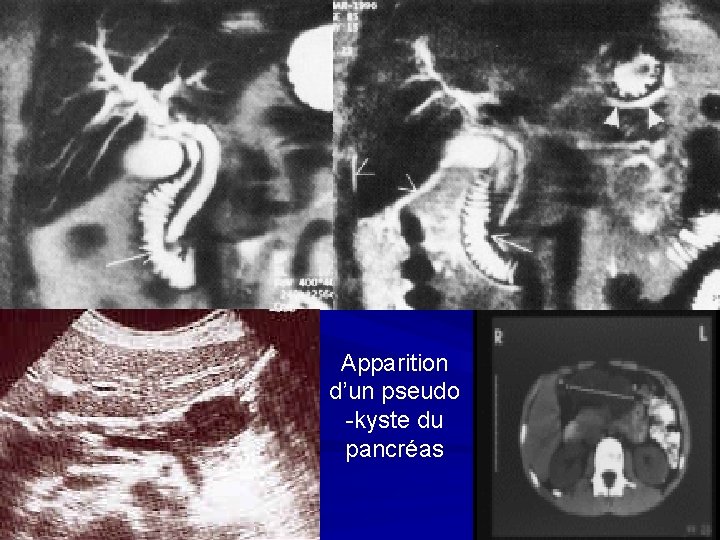 Apparition d’un pseudo -kyste du pancréas 