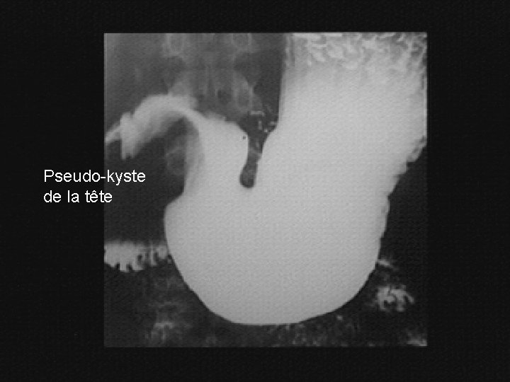 Pseudo-kyste de la tête 