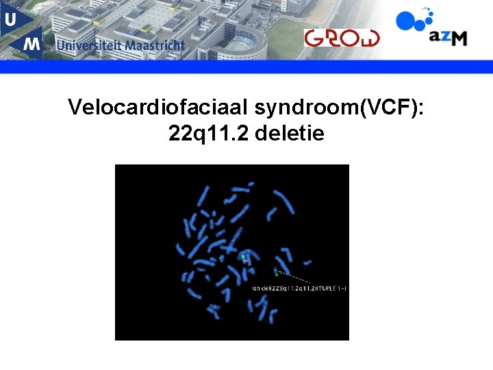 Velocardiofaciaal syndroom(VCF): 22 q 11. 2 deletie 