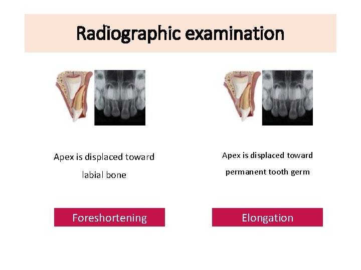 Radiographic examination Apex is displaced toward labial bone permanent tooth germ Foreshortening Elongation 